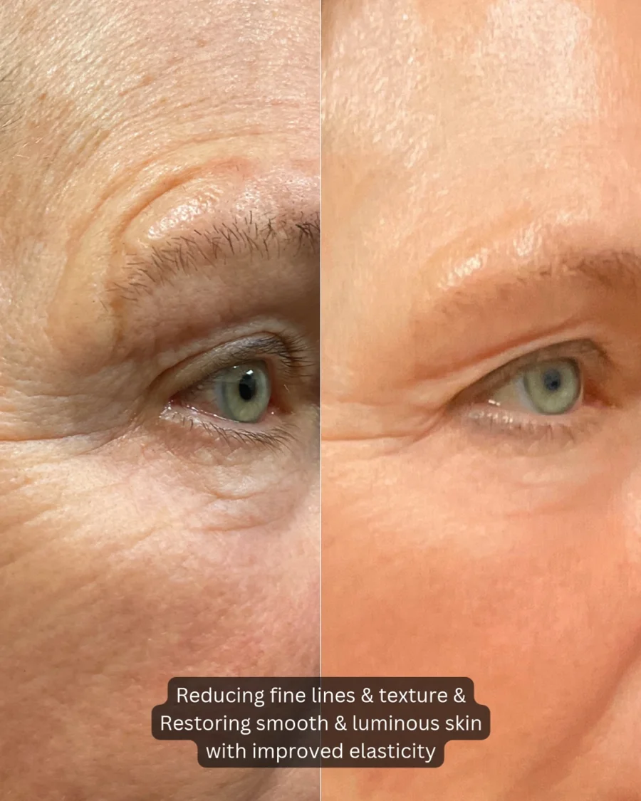 Before and after oculofacial plastic surgery results in Atlanta, GA, performed by Dr. Sahitya Reddy.