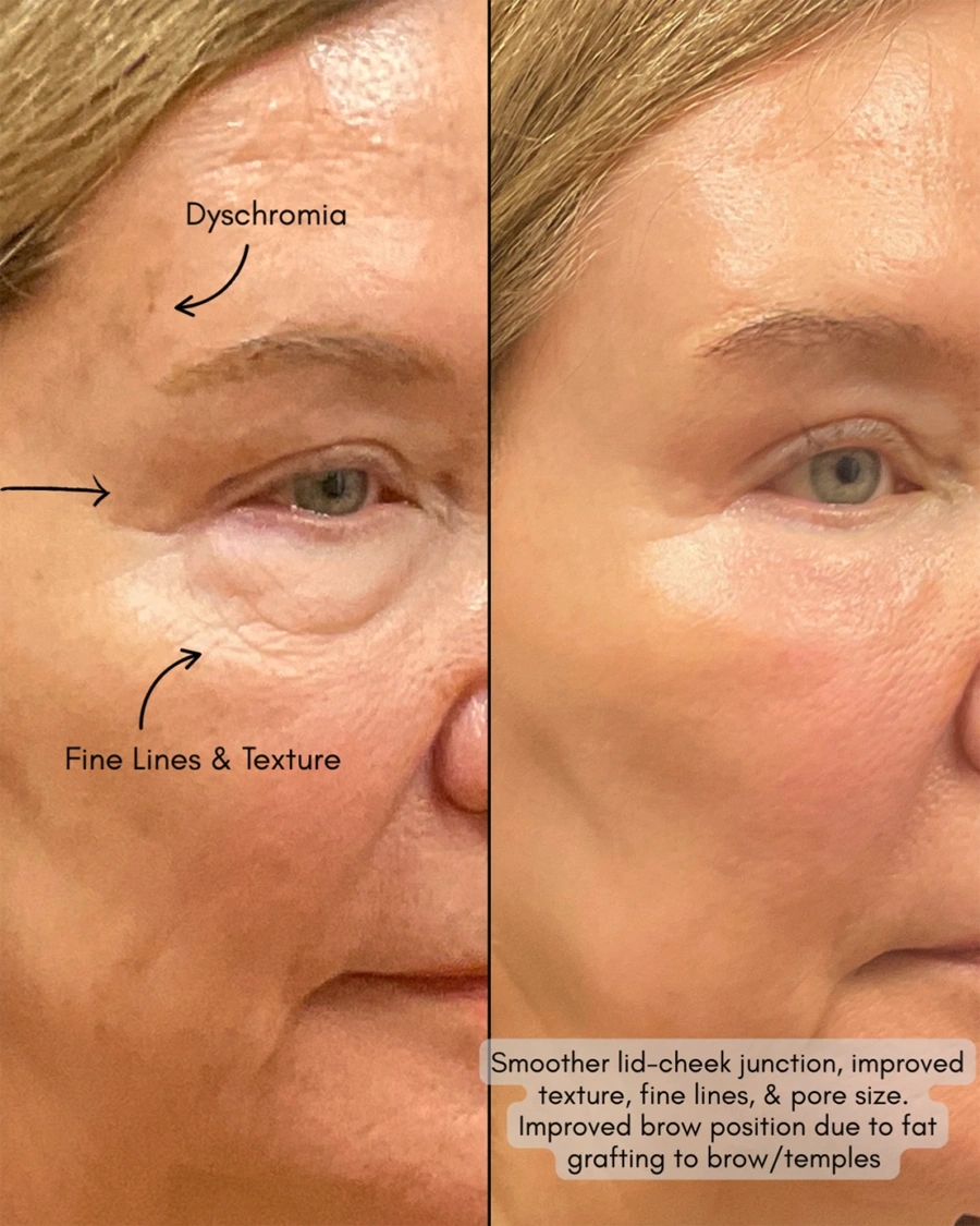 Before and after oculofacial plastic surgery results in Atlanta, GA, performed by Dr. Sahitya Reddy.