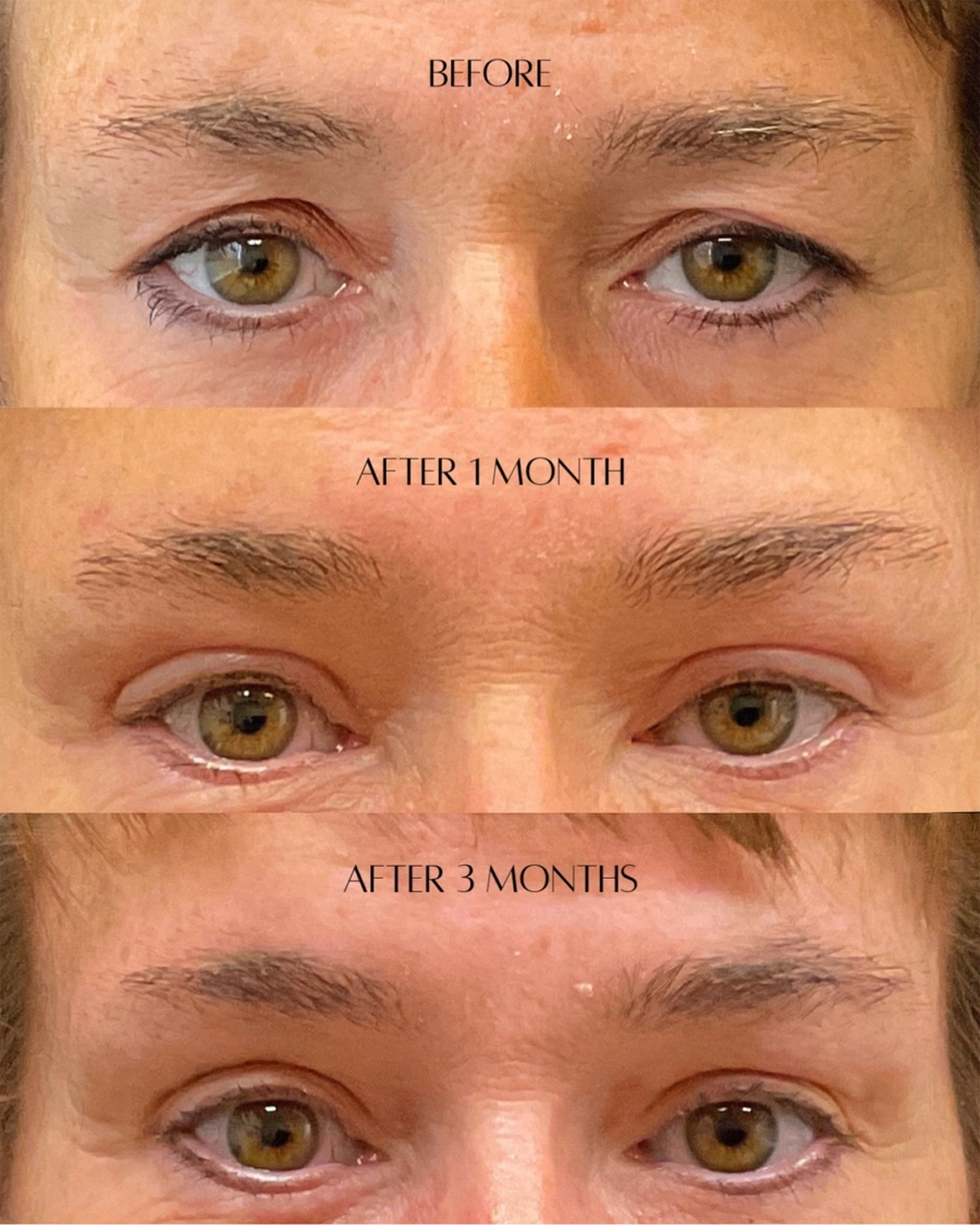 Before and after oculofacial plastic surgery results in Atlanta, GA, performed by Dr. Sahitya Reddy.