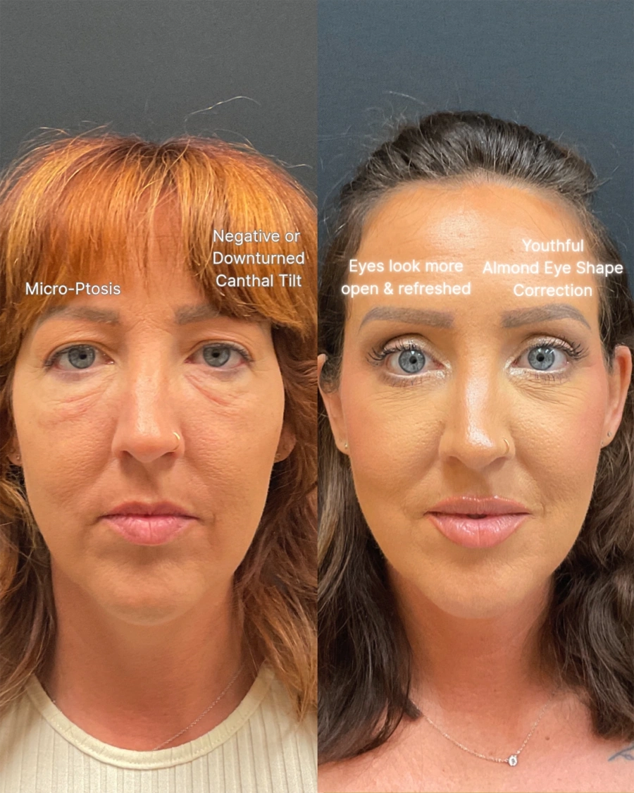 Before and after oculofacial plastic surgery results in Atlanta, GA, performed by Dr. Sahitya Reddy.