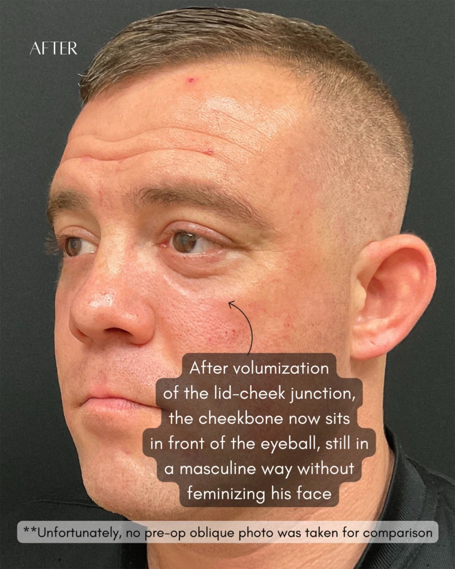 Before and after oculofacial plastic surgery results in Atlanta, GA, performed by Dr. Sahitya Reddy.