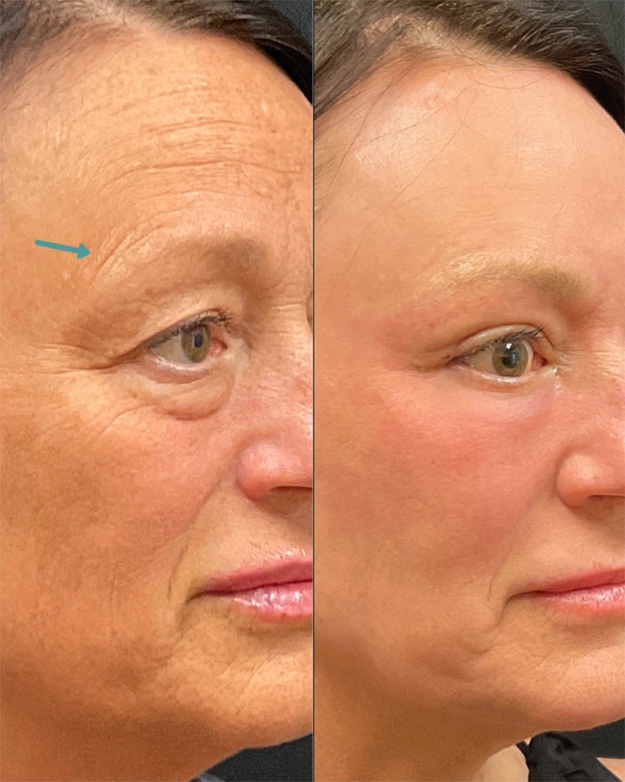 Before and after oculofacial plastic surgery results in Atlanta, GA, performed by Dr. Sahitya Reddy.