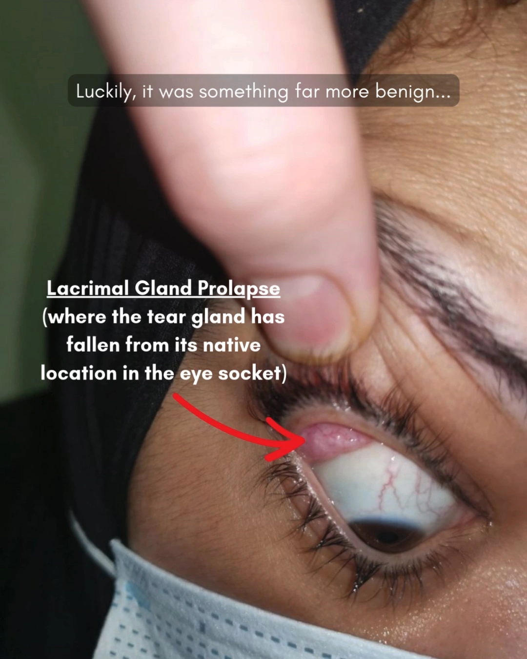 Before and after oculofacial plastic surgery results in Atlanta, GA, performed by Dr. Sahitya Reddy.