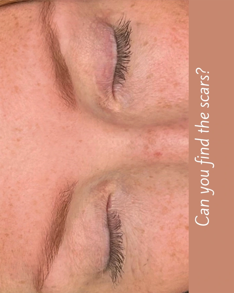 Before and after oculofacial plastic surgery results in Atlanta, GA, performed by Dr. Sahitya Reddy.