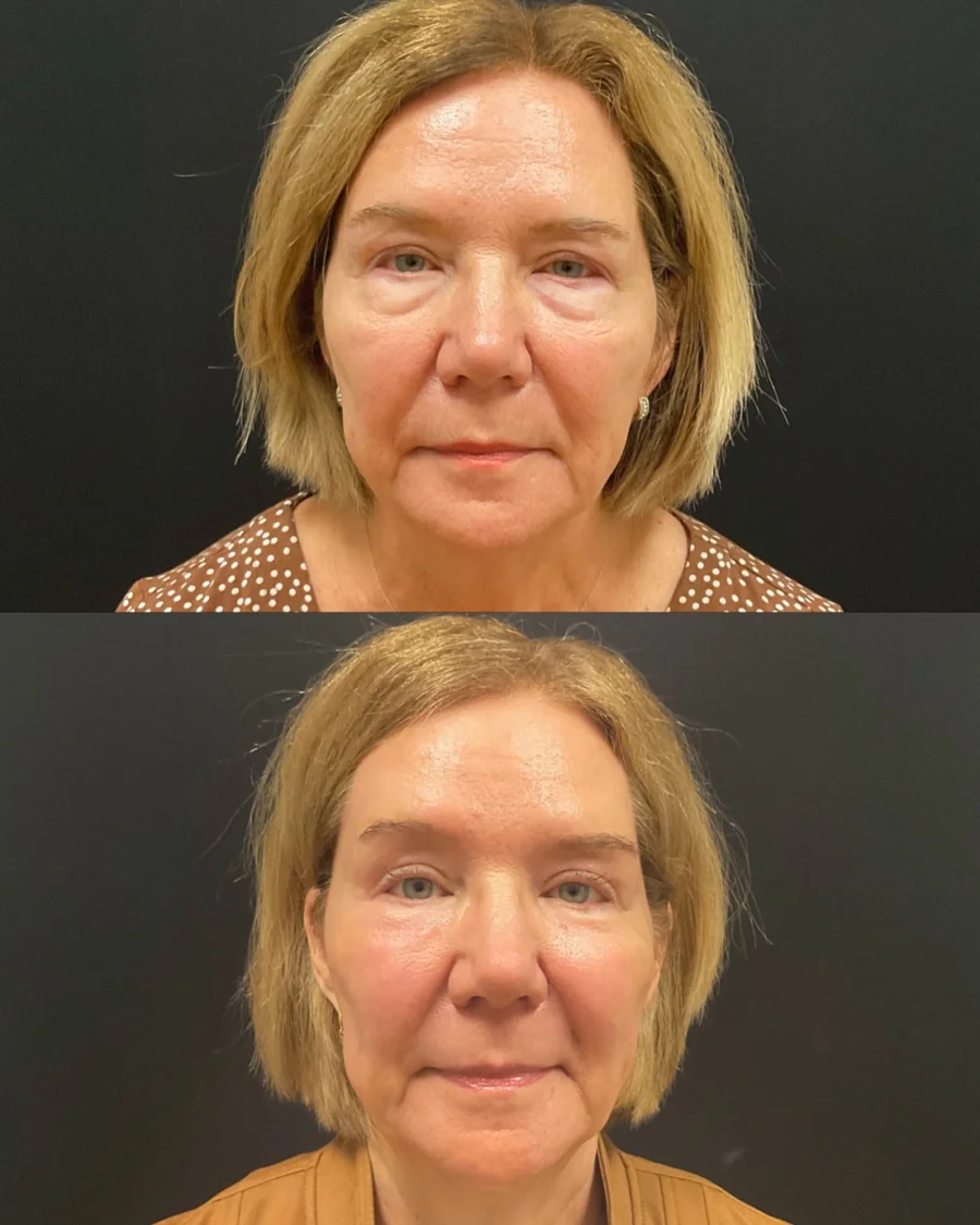 Before and after oculofacial plastic surgery results in Atlanta, GA, performed by Dr. Sahitya Reddy.