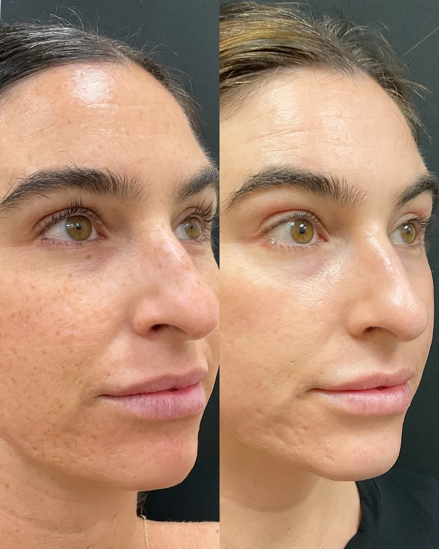 Before and after oculofacial plastic surgery results in Atlanta, GA, performed by Dr. Sahitya Reddy.