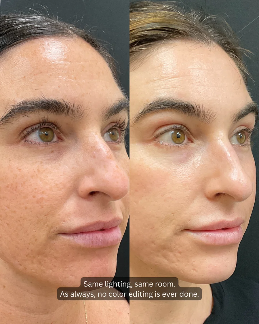 Before and after oculofacial plastic surgery results in Atlanta, GA, performed by Dr. Sahitya Reddy.