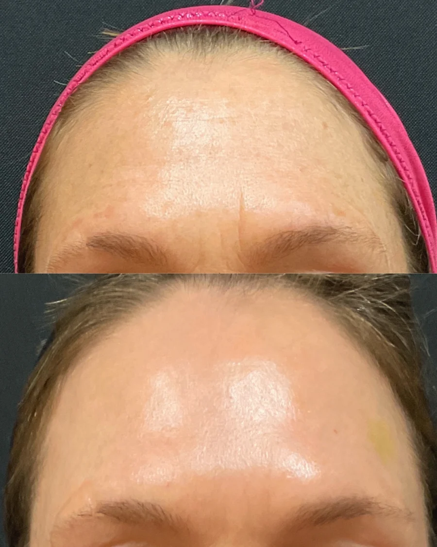Before and after oculofacial plastic surgery results in Atlanta, GA, performed by Dr. Sahitya Reddy.