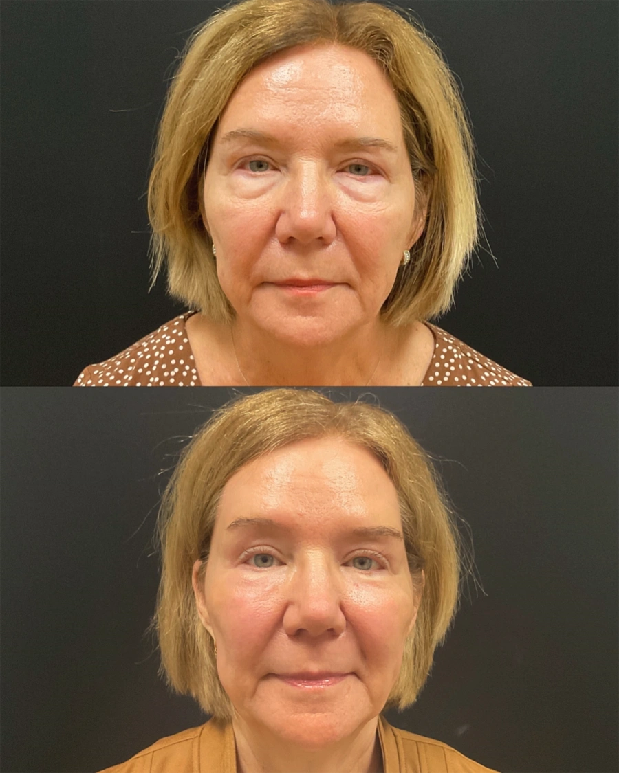 Before and after oculofacial plastic surgery results in Atlanta, GA, performed by Dr. Sahitya Reddy.