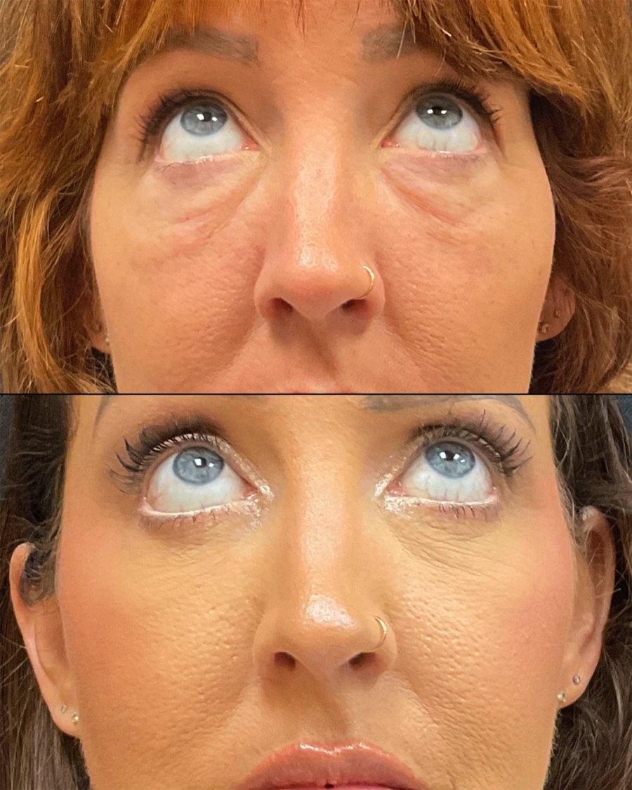 Before and after oculofacial plastic surgery results in Atlanta, GA, performed by Dr. Sahitya Reddy.