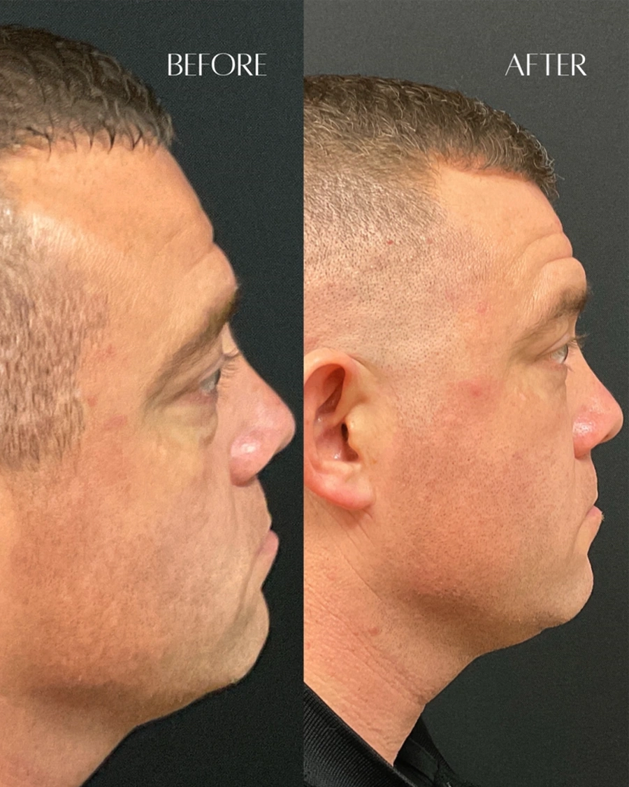 Before and after oculofacial plastic surgery results in Atlanta, GA, performed by Dr. Sahitya Reddy.
