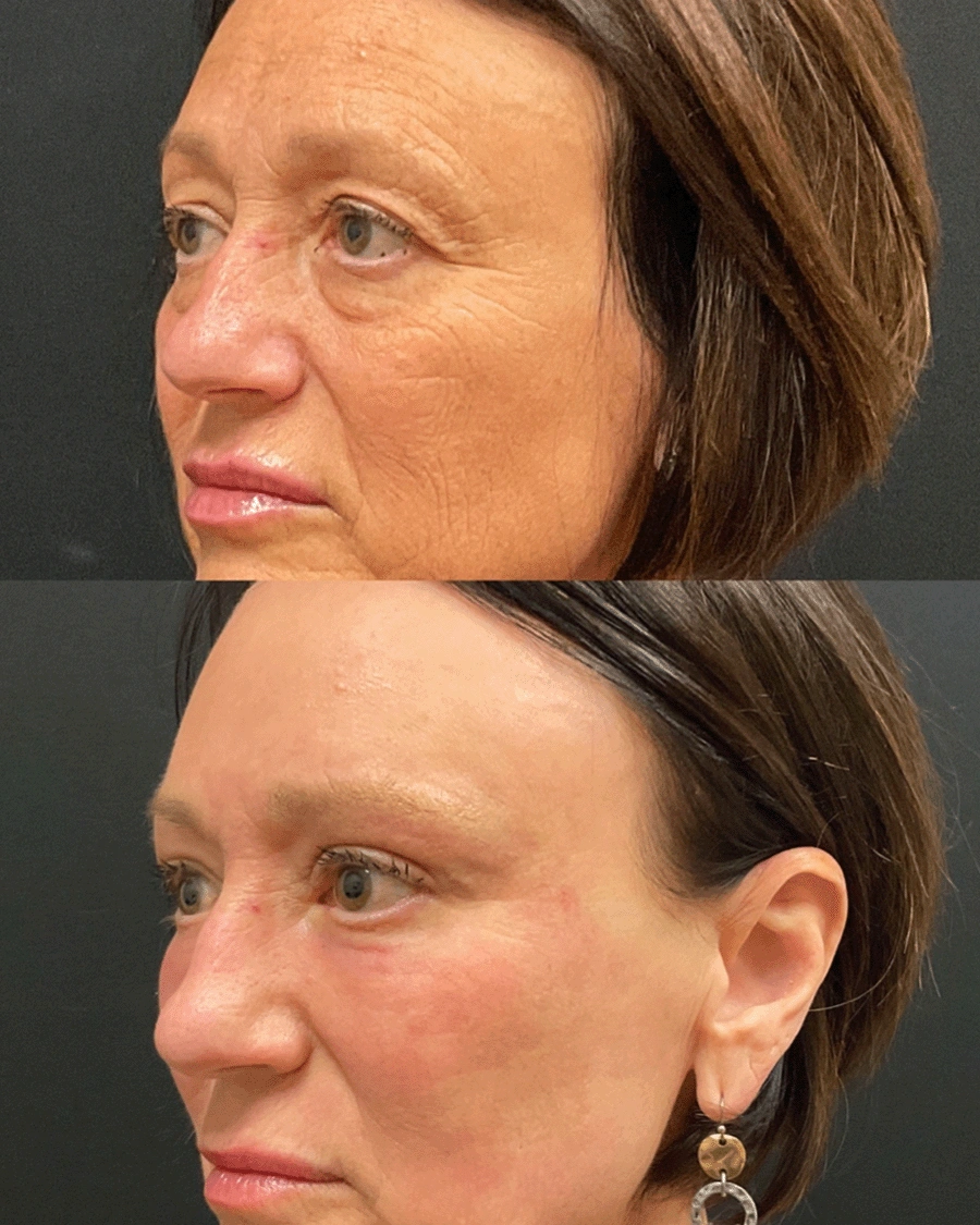 Before and after oculofacial plastic surgery results in Atlanta, GA, performed by Dr. Sahitya Reddy.