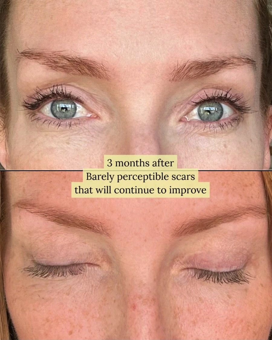 Before and after oculofacial plastic surgery results in Atlanta, GA, performed by Dr. Sahitya Reddy.