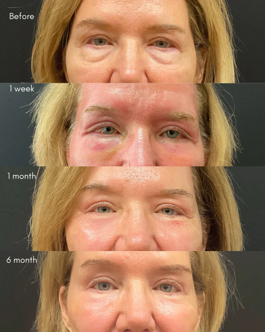 Before and after oculofacial plastic surgery results in Atlanta, GA, performed by Dr. Sahitya Reddy.