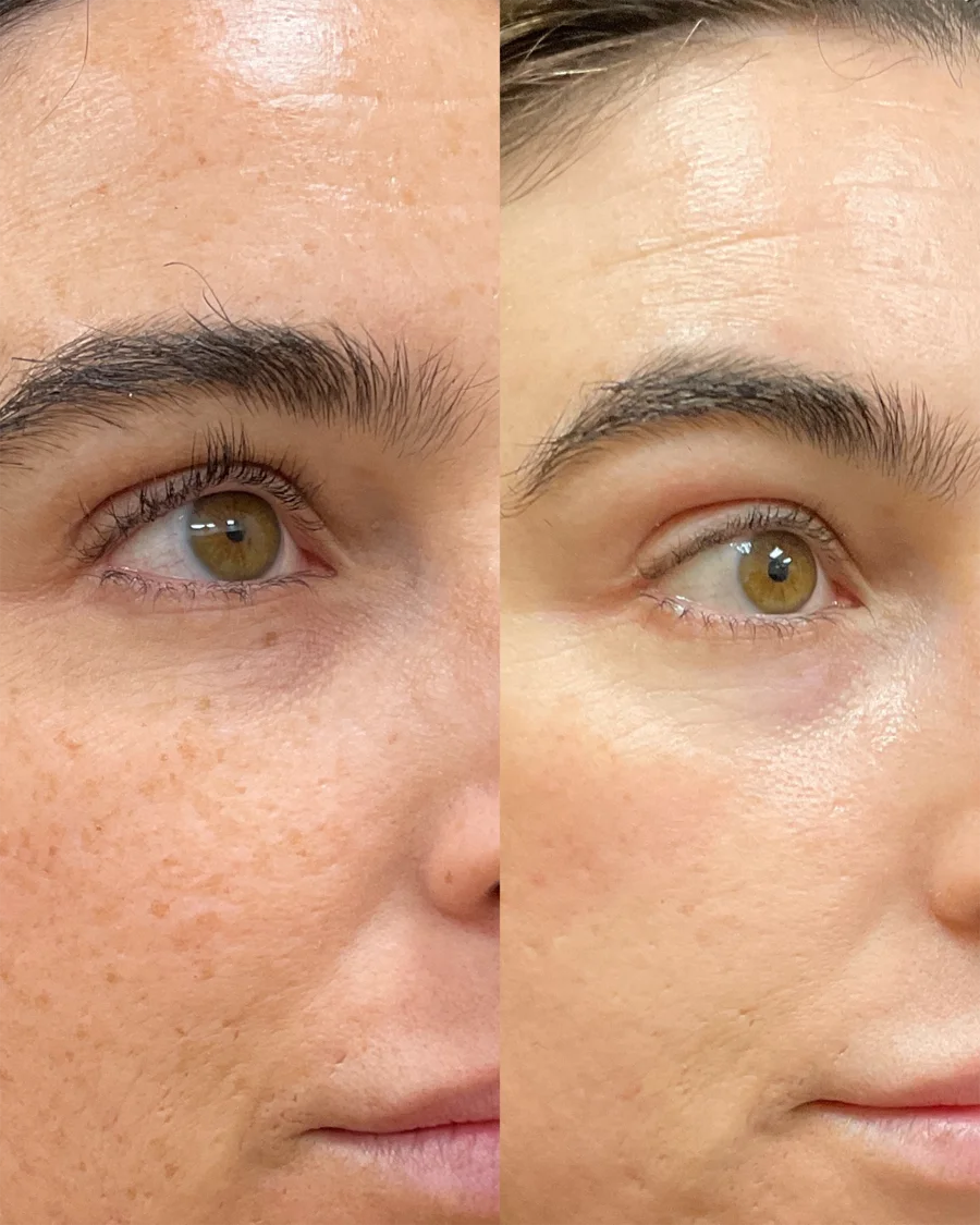 Before and after oculofacial plastic surgery results in Atlanta, GA, performed by Dr. Sahitya Reddy.