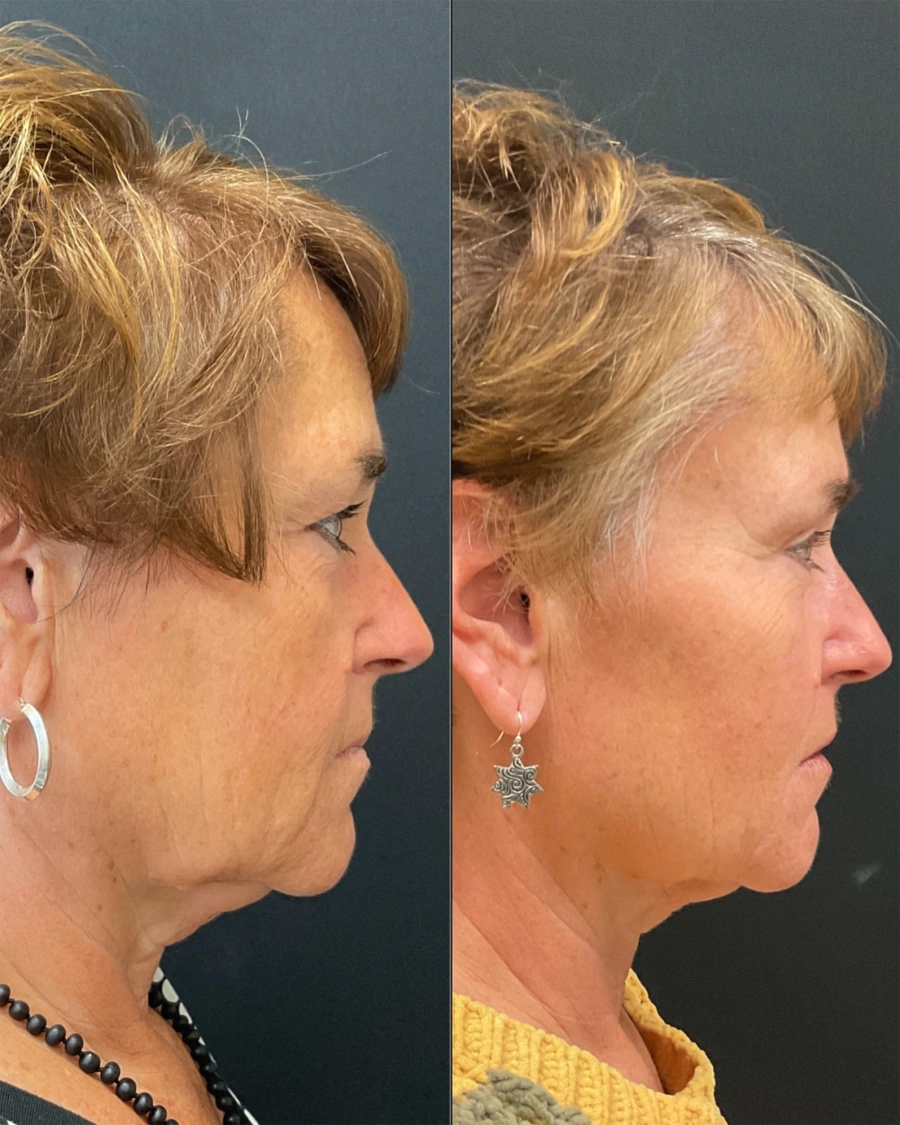 Before and after oculofacial plastic surgery results in Atlanta, GA, performed by Dr. Sahitya Reddy.