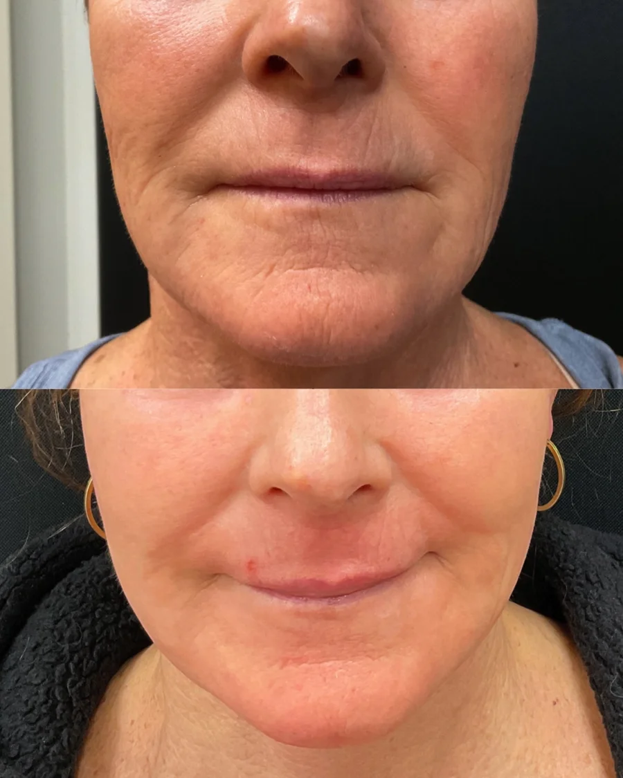 Before and after oculofacial plastic surgery results in Atlanta, GA, performed by Dr. Sahitya Reddy.