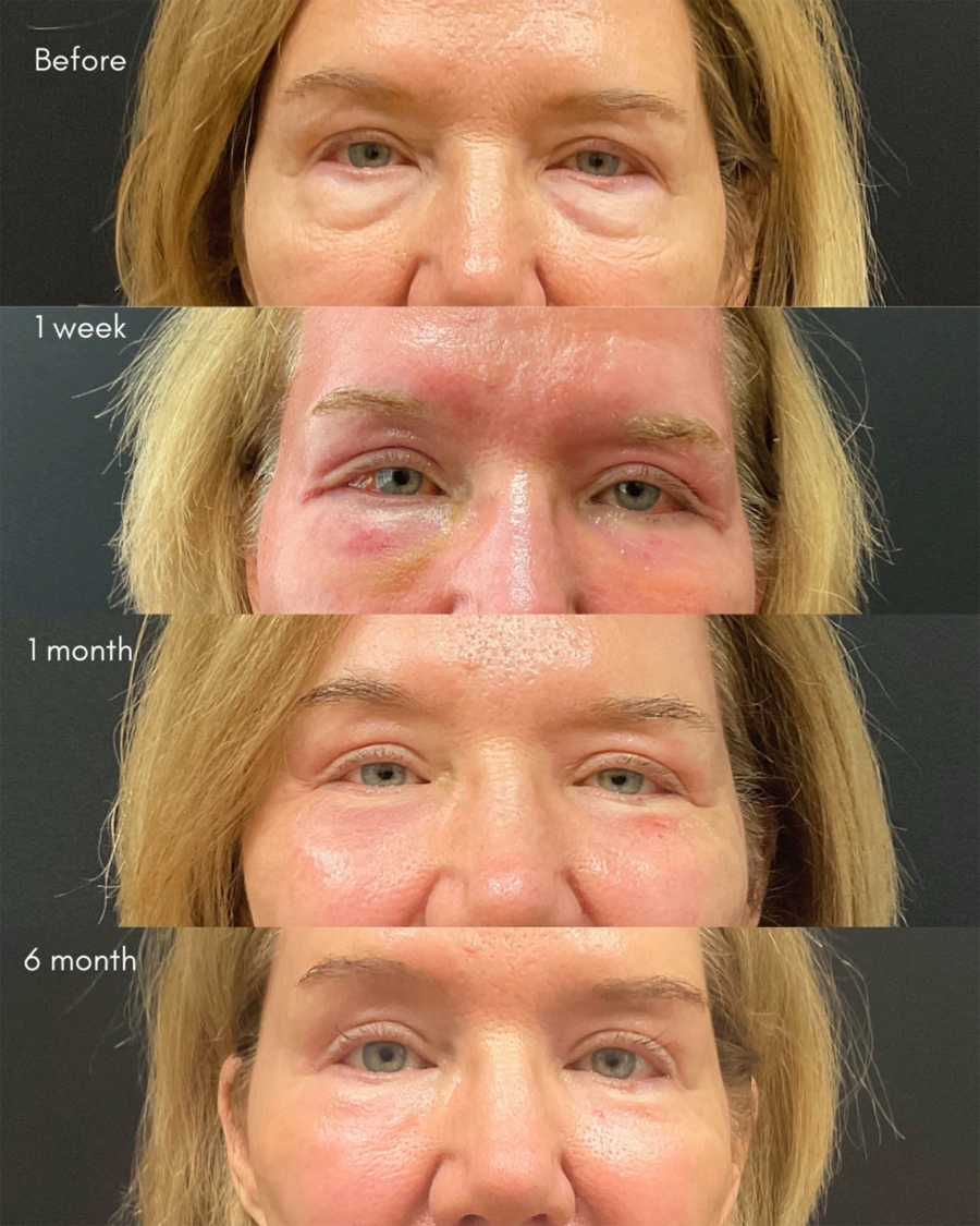 Before and after oculofacial plastic surgery results in Atlanta, GA, performed by Dr. Sahitya Reddy.