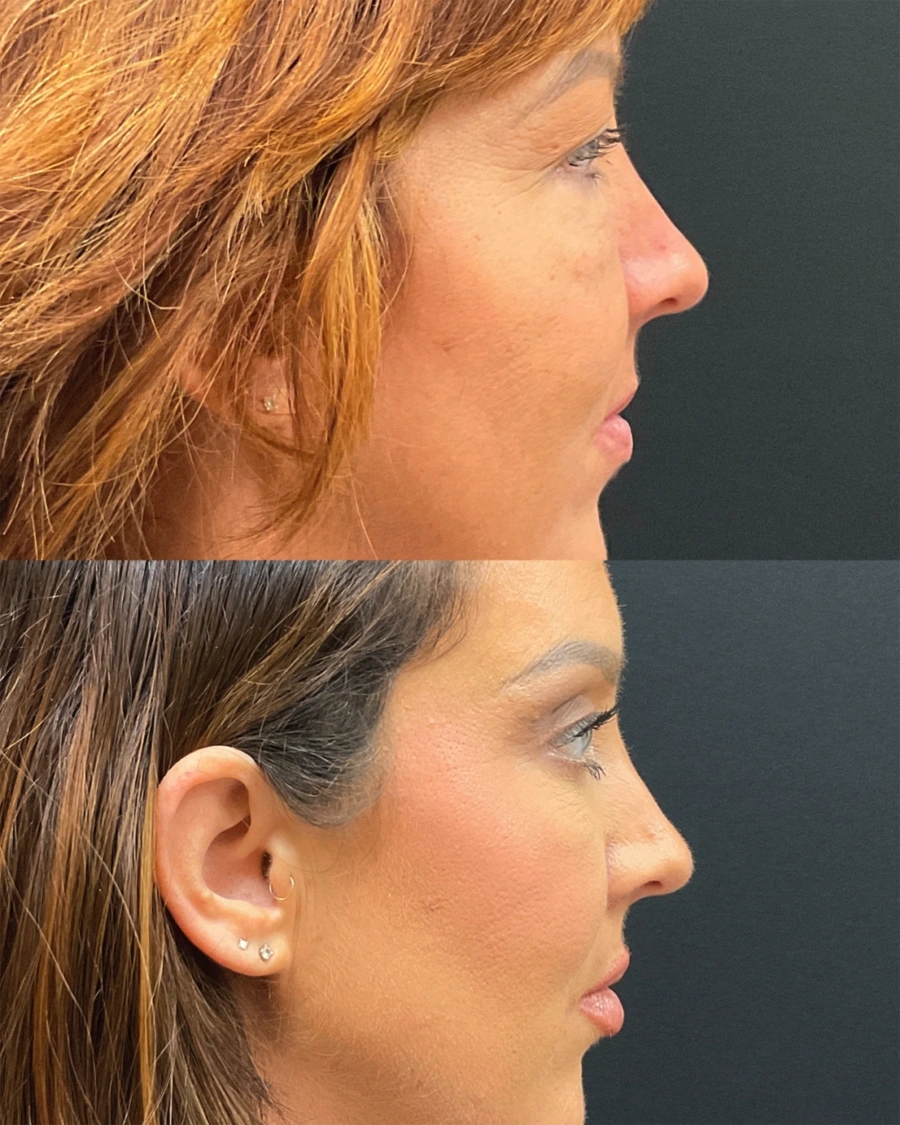 Before and after oculofacial plastic surgery results in Atlanta, GA, performed by Dr. Sahitya Reddy.
