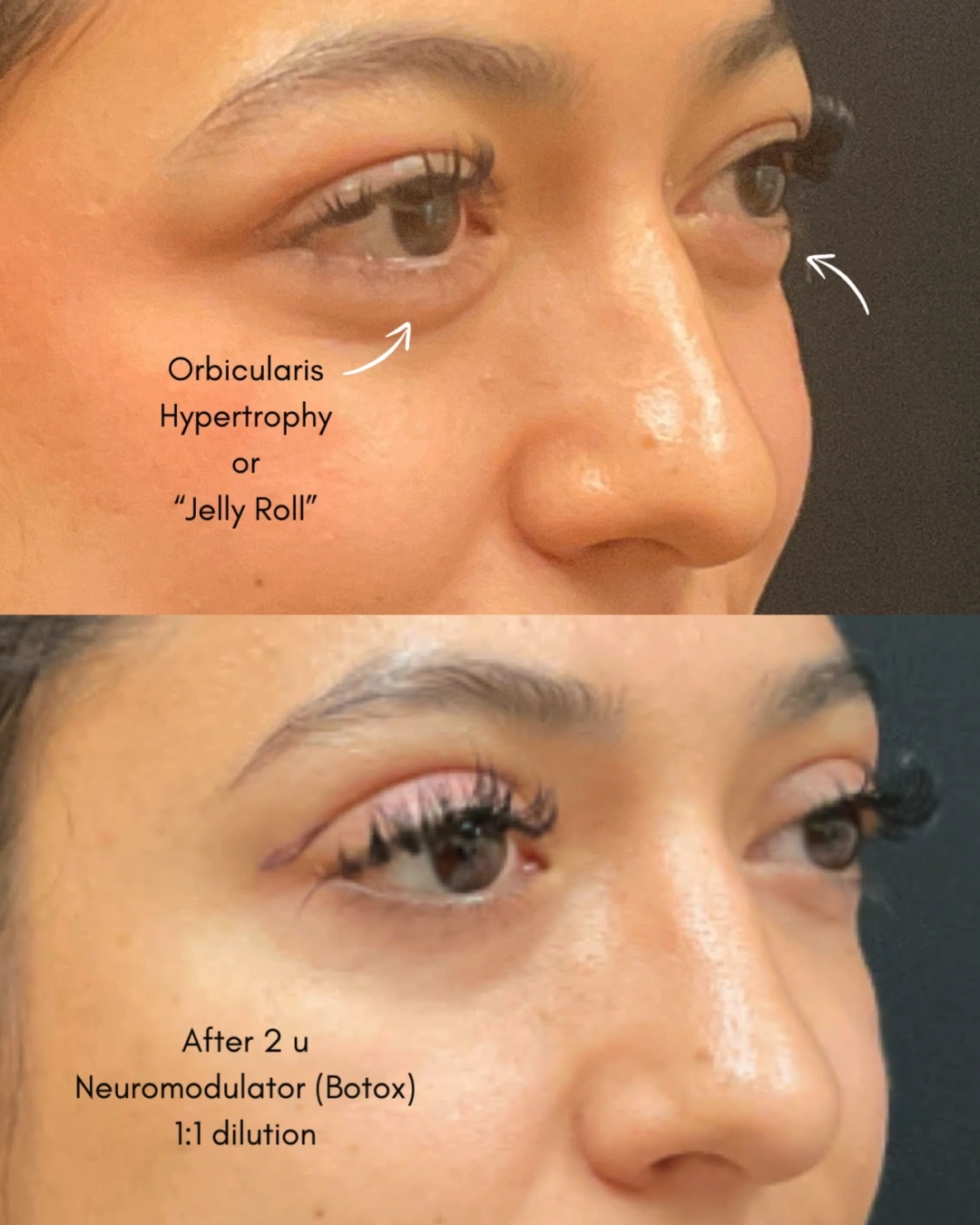 Before and after oculofacial plastic surgery results in Atlanta, GA, performed by Dr. Sahitya Reddy.