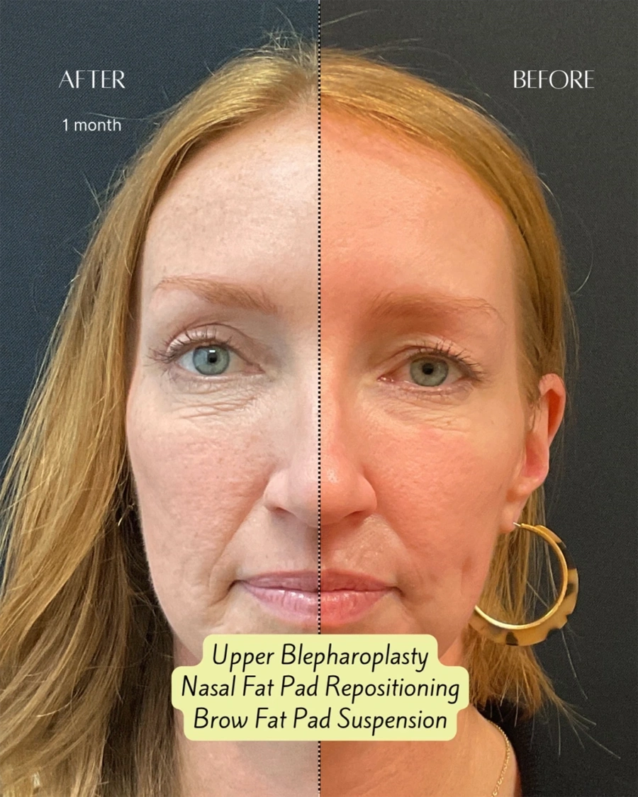 Before and after oculofacial plastic surgery results in Atlanta, GA, performed by Dr. Sahitya Reddy.