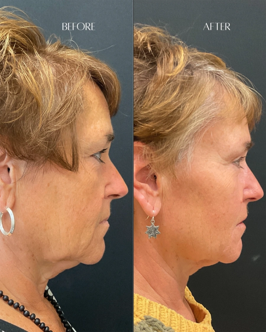 Before and after oculofacial plastic surgery results in Atlanta, GA, performed by Dr. Sahitya Reddy.
