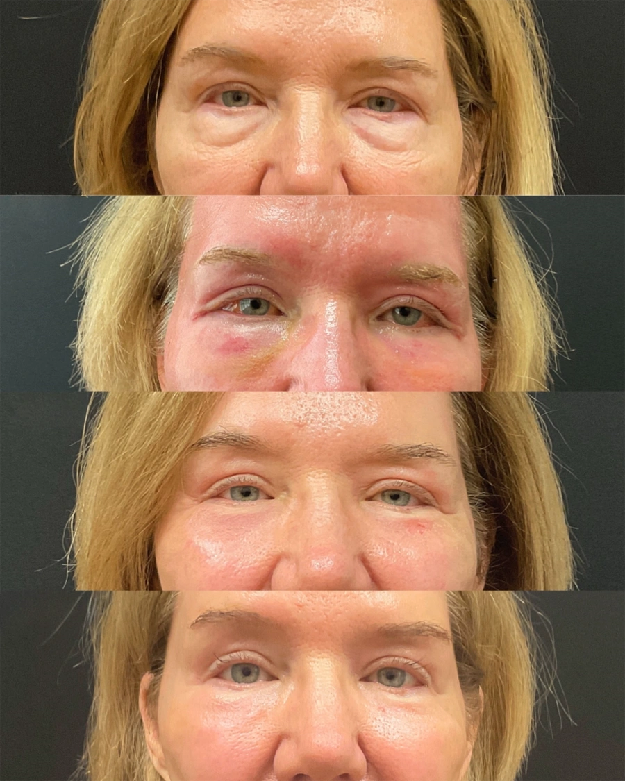 Before and after oculofacial plastic surgery results in Atlanta, GA, performed by Dr. Sahitya Reddy.