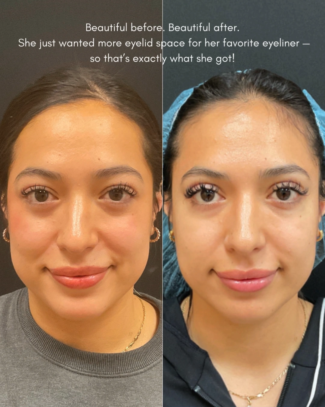 Before and after oculofacial plastic surgery results in Atlanta, GA, performed by Dr. Sahitya Reddy.