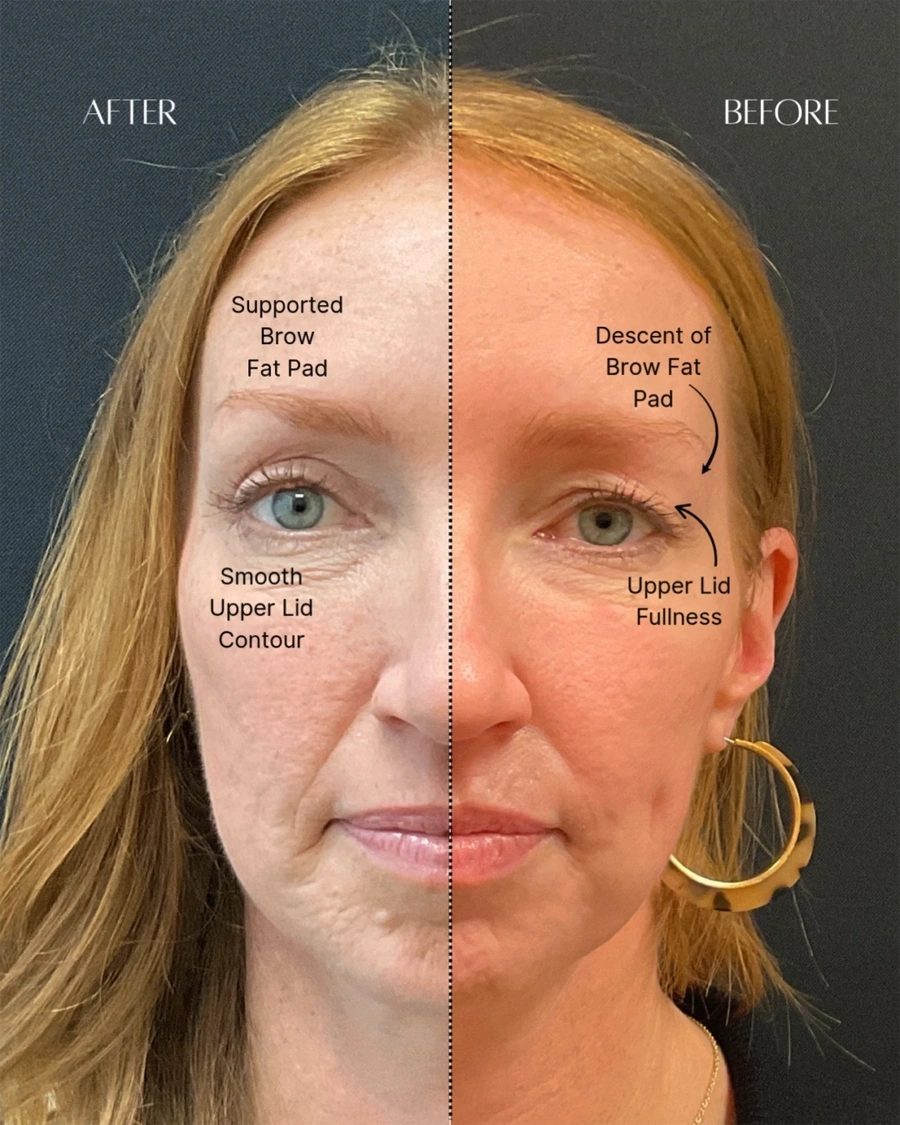 Before and after oculofacial plastic surgery results in Atlanta, GA, performed by Dr. Sahitya Reddy.