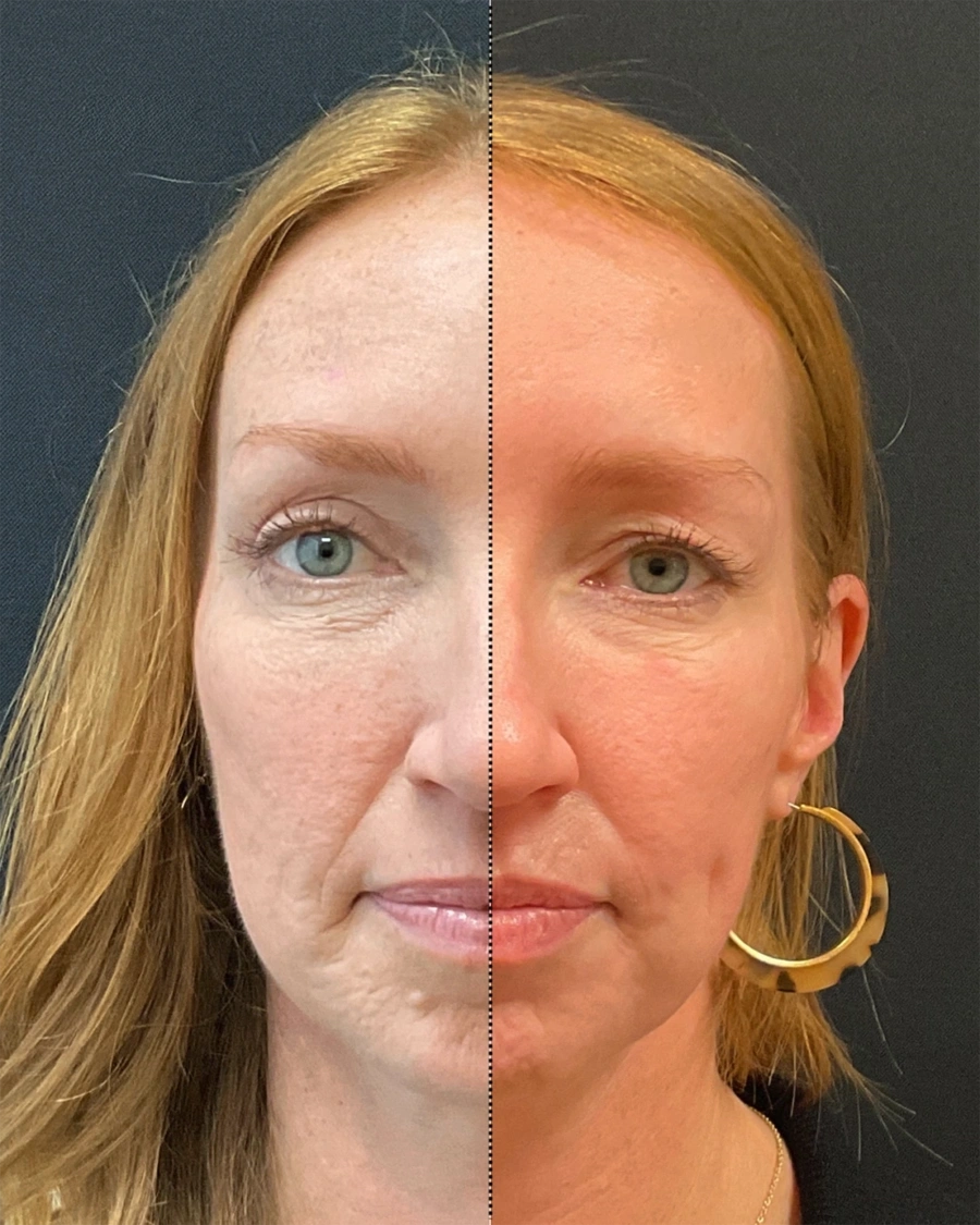 Before and after oculofacial plastic surgery results in Atlanta, GA, performed by Dr. Sahitya Reddy.