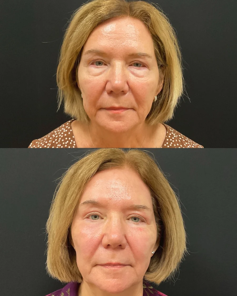 Before and after oculofacial plastic surgery results in Atlanta, GA, performed by Dr. Sahitya Reddy.