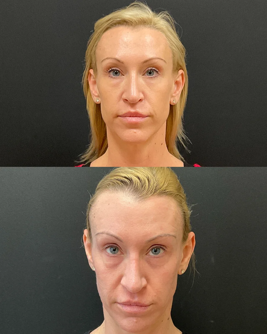 Before and after oculofacial plastic surgery results in Atlanta, GA, performed by Dr. Sahitya Reddy.