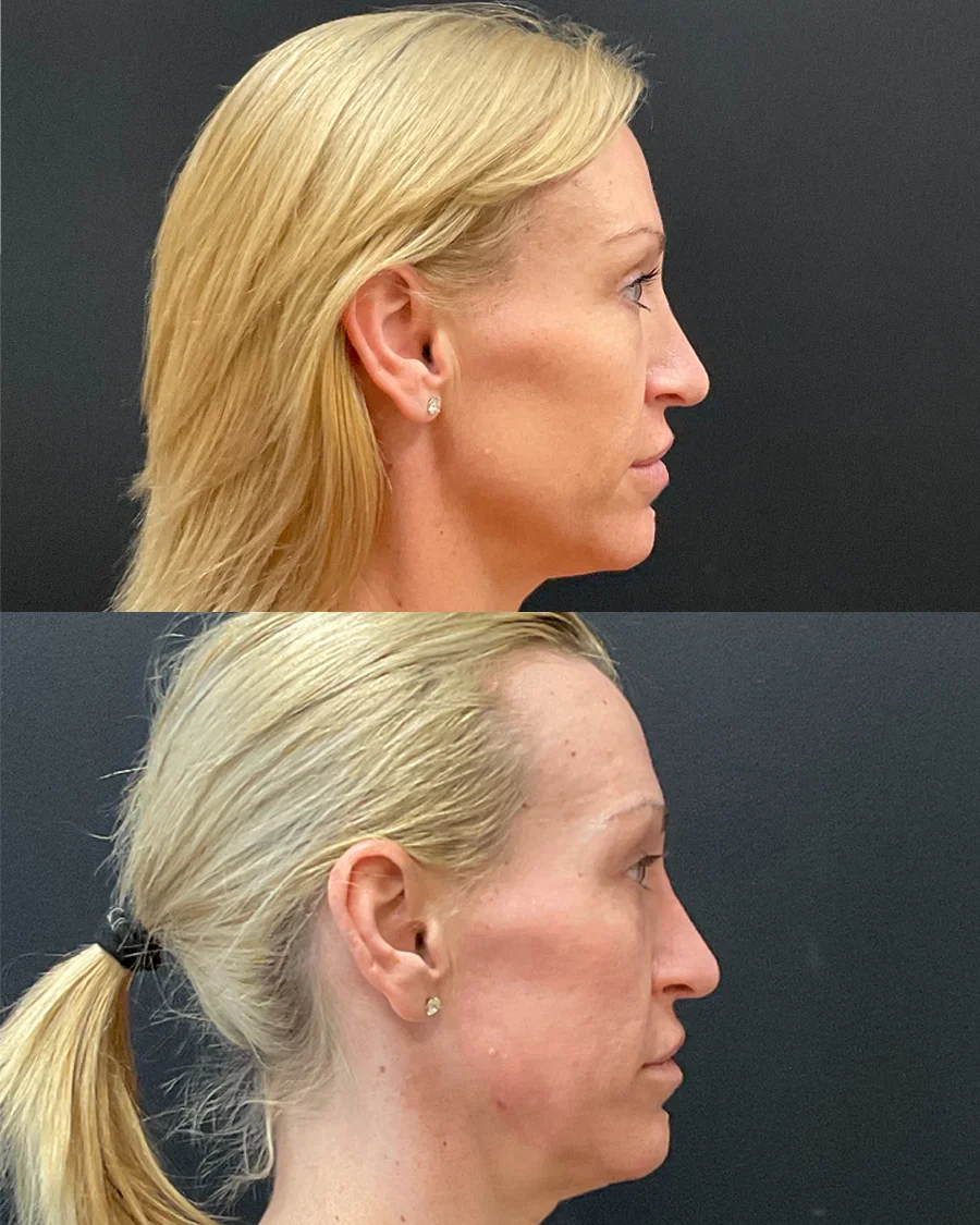 Before and after oculofacial plastic surgery results in Atlanta, GA, performed by Dr. Sahitya Reddy.