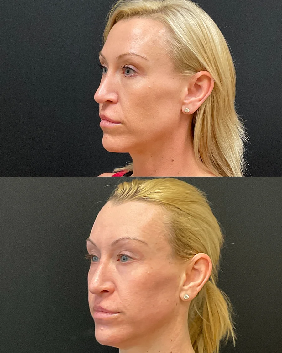 Before and after oculofacial plastic surgery results in Atlanta, GA, performed by Dr. Sahitya Reddy.