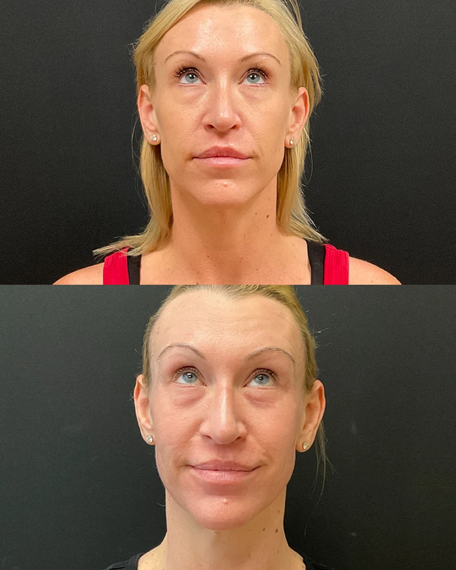 Before and after oculofacial plastic surgery results in Atlanta, GA, performed by Dr. Sahitya Reddy.