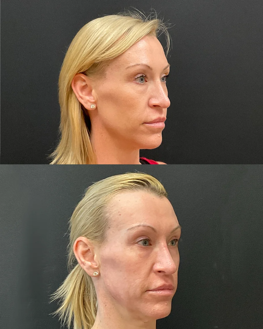 Before and after oculofacial plastic surgery results in Atlanta, GA, performed by Dr. Sahitya Reddy.