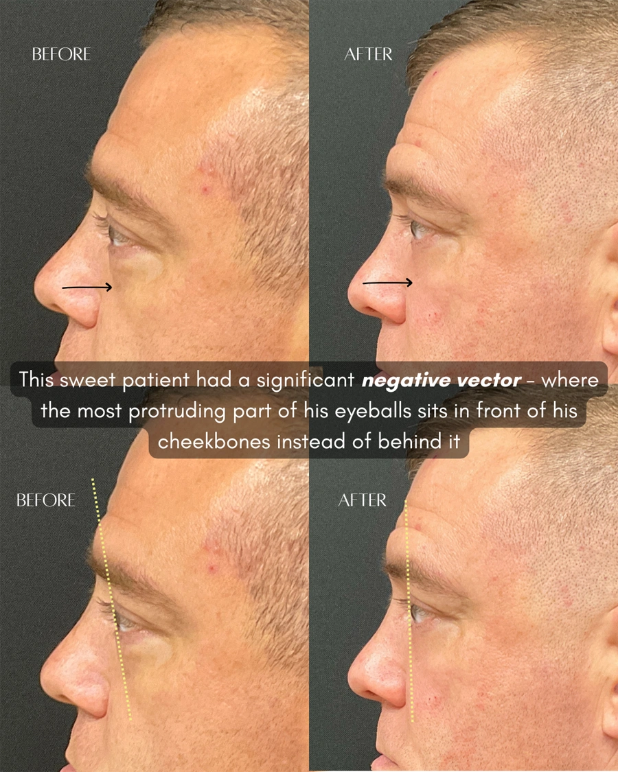 Before and after oculofacial plastic surgery results in Atlanta, GA, performed by Dr. Sahitya Reddy.
