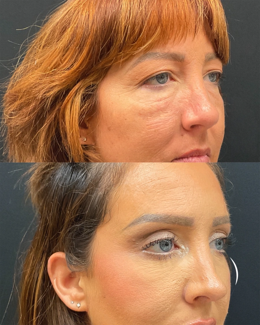 Before and after oculofacial plastic surgery results in Atlanta, GA, performed by Dr. Sahitya Reddy.