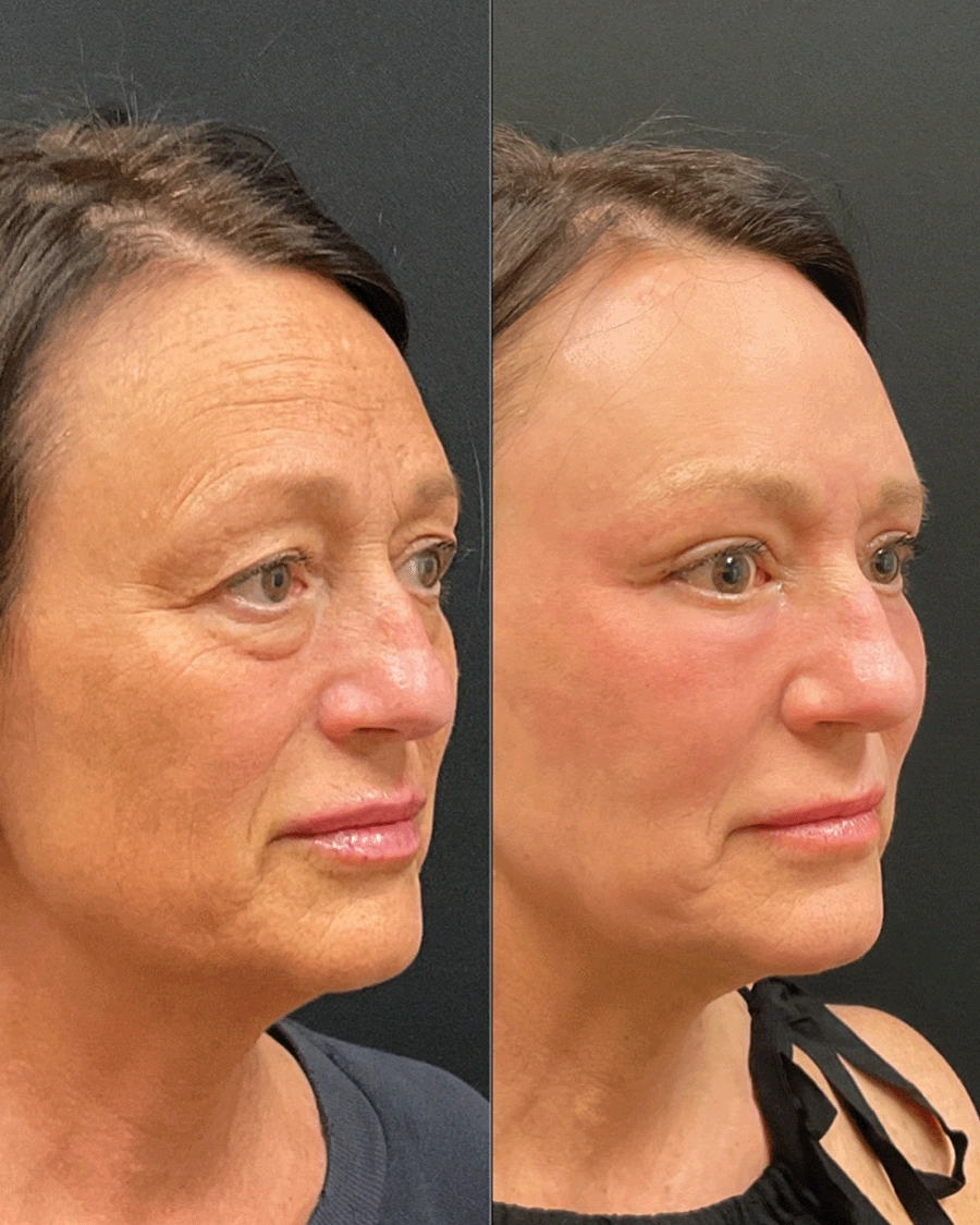 Before and after oculofacial plastic surgery results in Atlanta, GA, performed by Dr. Sahitya Reddy.