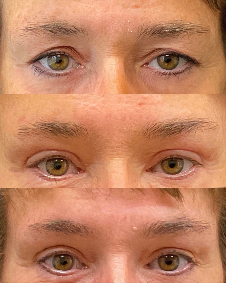 Before and after oculofacial plastic surgery results in Atlanta, GA, performed by Dr. Sahitya Reddy.