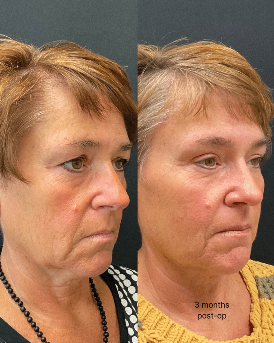 Before and after oculofacial plastic surgery results in Atlanta, GA, performed by Dr. Sahitya Reddy.