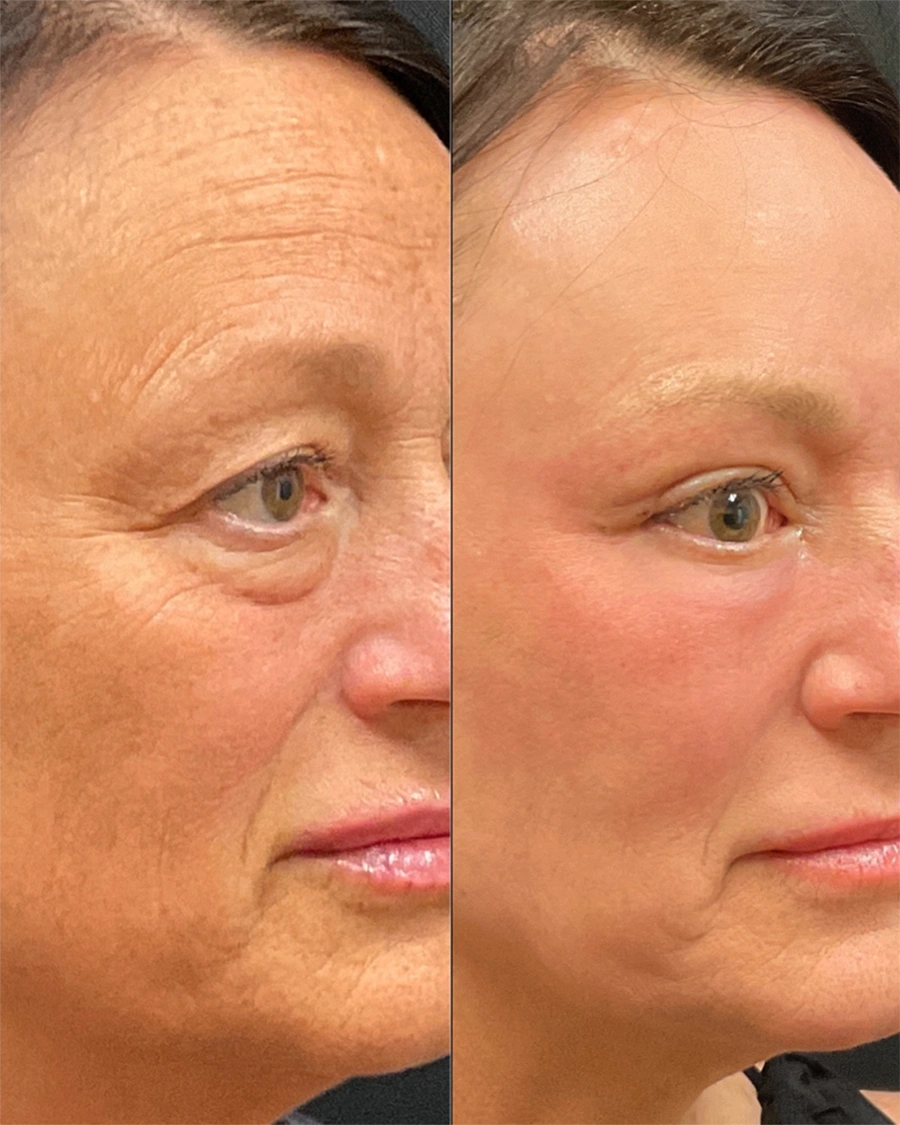 Before and after oculofacial plastic surgery results in Atlanta, GA, performed by Dr. Sahitya Reddy.