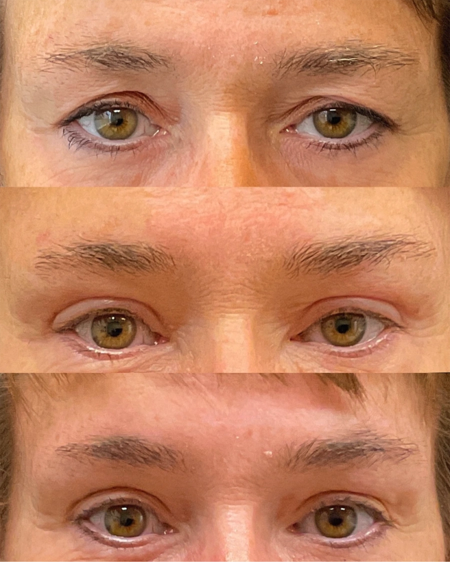 Before and after oculofacial plastic surgery results in Atlanta, GA, performed by Dr. Sahitya Reddy.