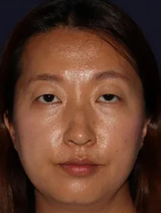 Before and after oculofacial plastic surgery results in Atlanta, GA, performed by Dr. Sahitya Reddy.