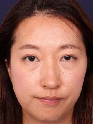 Before and after oculofacial plastic surgery results in Atlanta, GA, performed by Dr. Sahitya Reddy.
