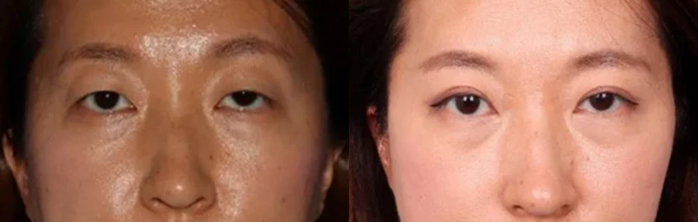 Before and after oculofacial plastic surgery results in Atlanta, GA, performed by Dr. Sahitya Reddy.