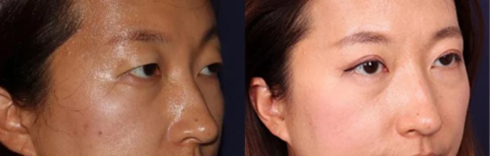Before and after oculofacial plastic surgery results in Atlanta, GA, performed by Dr. Sahitya Reddy.