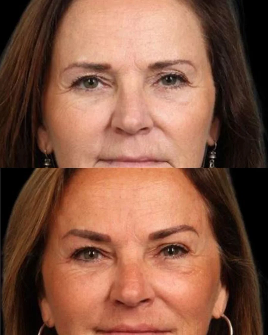 Before and after oculofacial plastic surgery results in Atlanta, GA, performed by Dr. Sahitya Reddy.