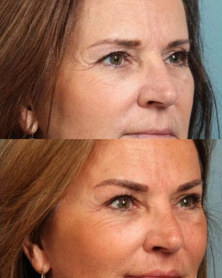 Before and after oculofacial plastic surgery results in Atlanta, GA, performed by Dr. Sahitya Reddy.