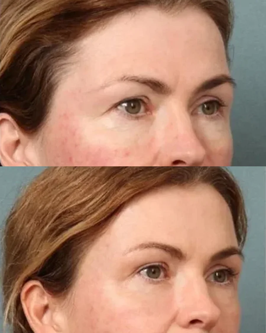 Before and after oculofacial plastic surgery results in Atlanta, GA, performed by Dr. Sahitya Reddy.
